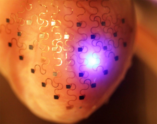 3-D printed electronic membranes to prevent heart attacks