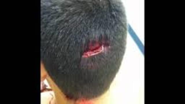 Accadentaly cracked my brothers head open