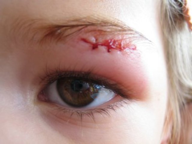 Snitches Get Stitches