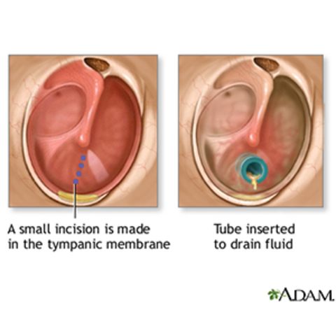Surgery to get tubes removed