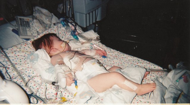 Second Heart surgery