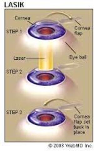 Laser eye surgery