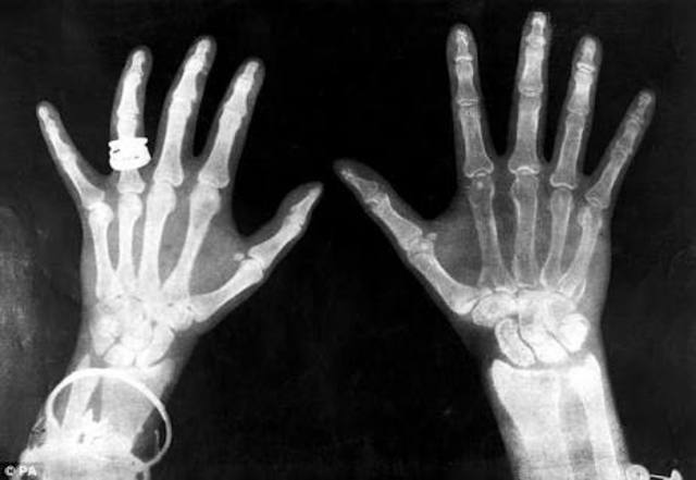 Wilhelm von Roentgen Discovers X-Rays