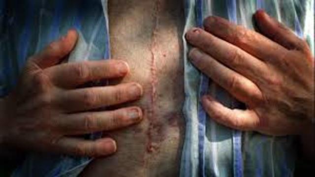 Artificial Heart transplant; one human to another