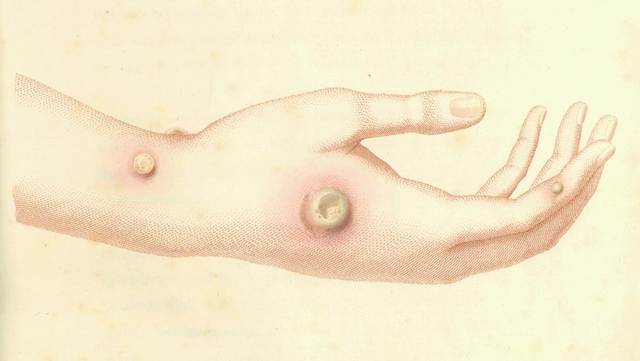 Smallpox Vaccine: Jenner's First Test