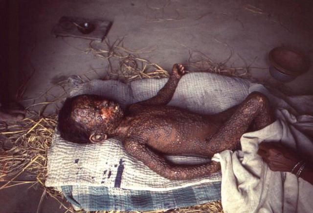 Smallpox in Somallia