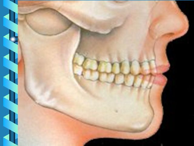 Máxima Intercuspidación