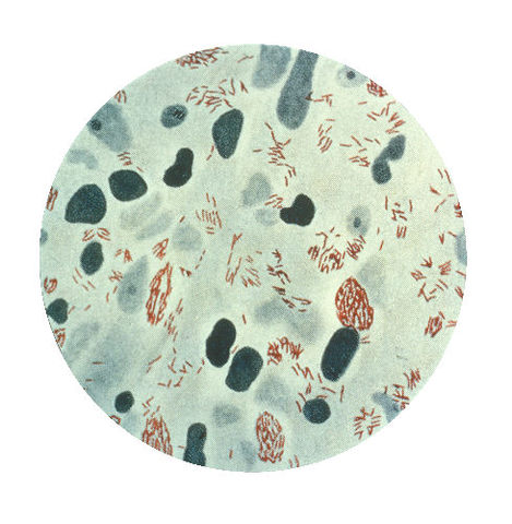Mycobacterium leprae felfedezése