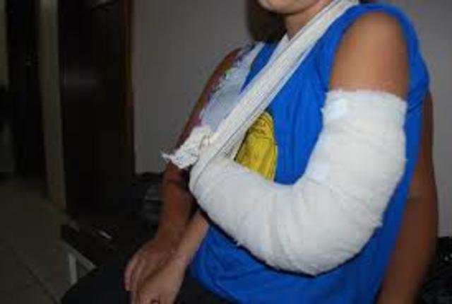 Quebrei o outro braço