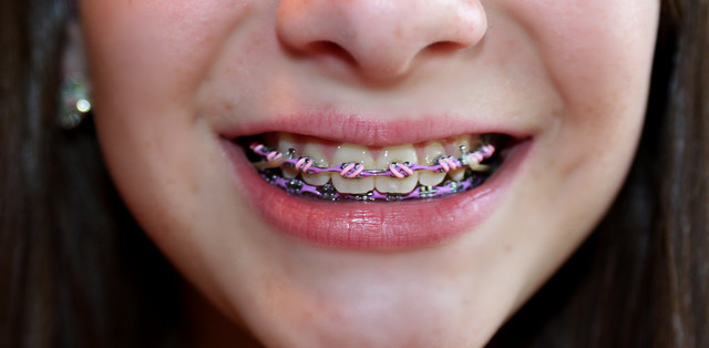 Braces