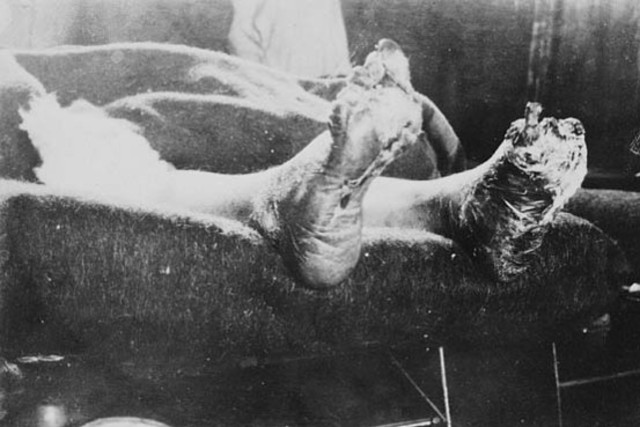 Shell shock, trench foot, and trench mouth