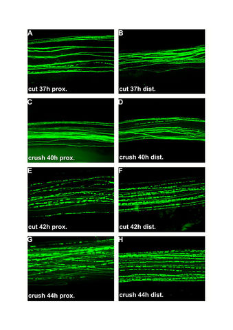 Degeneración Walleriana