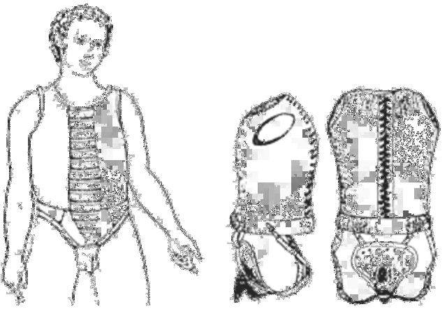 Severe Punishments for Masturbation