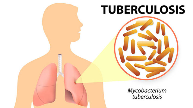 Control de la tuberculosis