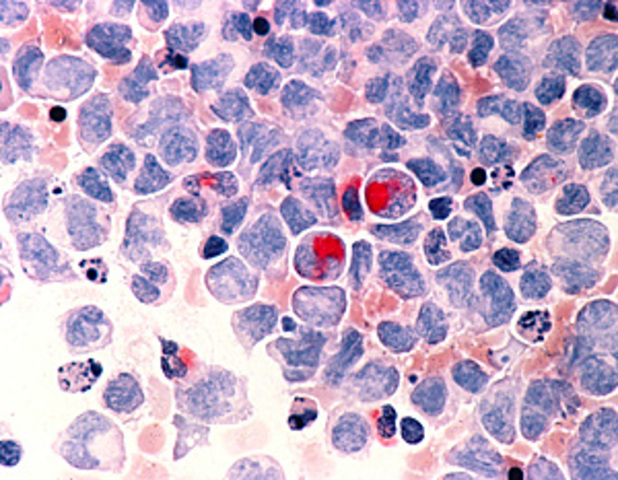 Secuencia por primera vez el genoma del cáncer.