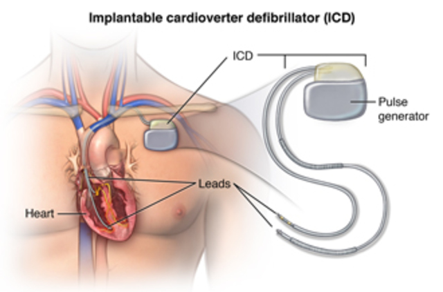 Implantable Cardioverter Defibrillator (ICD)