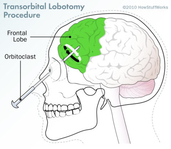 Lobotomy