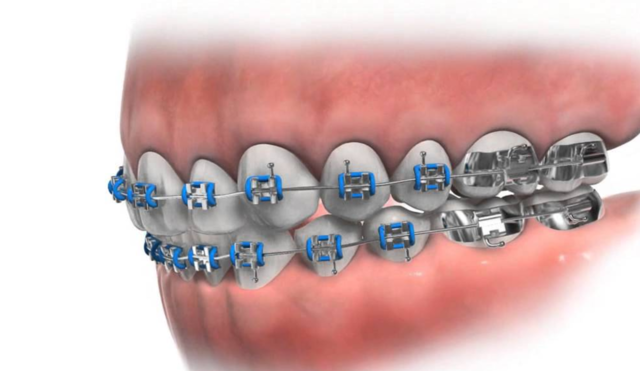 Me pusieron frenillos en 2011