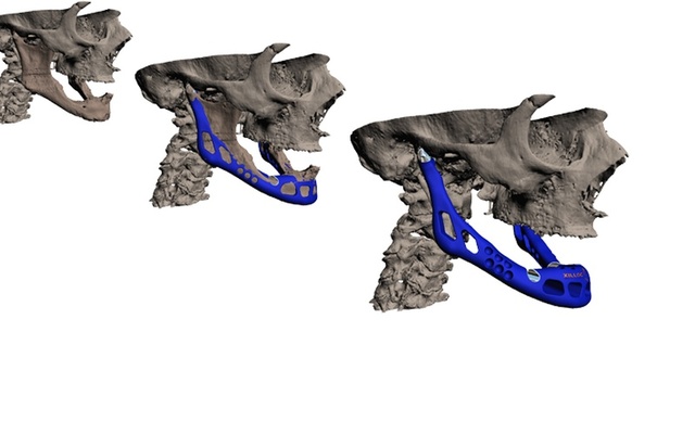 IMPLANTE DE PRÓTESIS DE MANDÍBULA IMPRESA EN 3D.