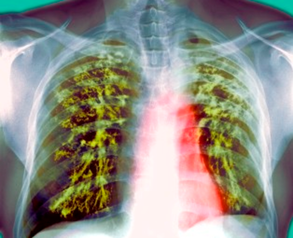 Tuberculosis