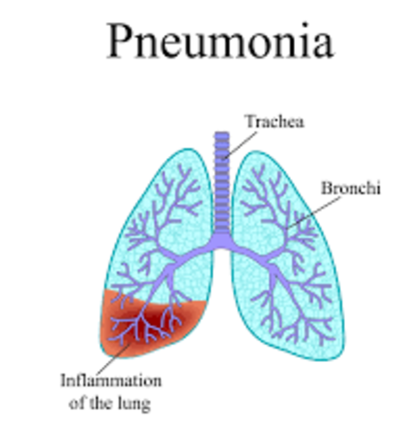 Pneumonia
