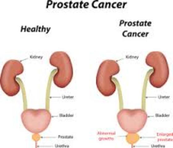 Got prostate cancer