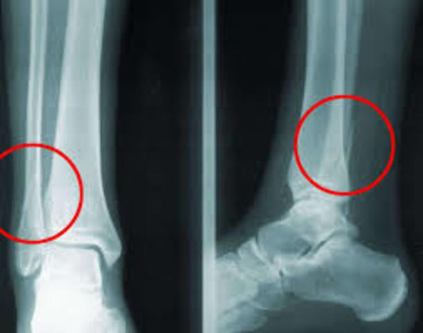 Enfermo- de una Fractura de perone