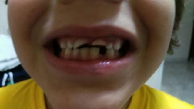 Dientes rotos
