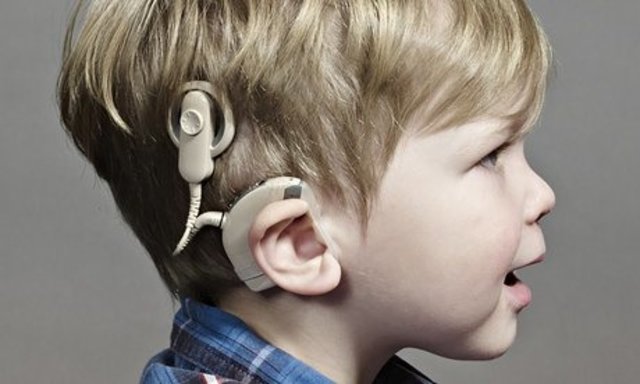 Cochlear Implants