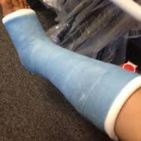 broke my Leg