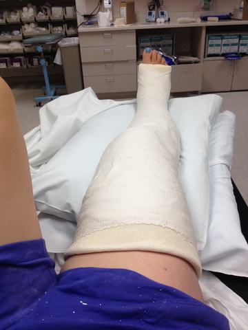I broke my leg for the first time.