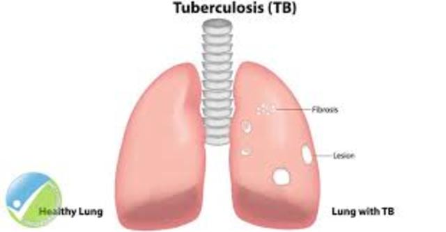 tubercular