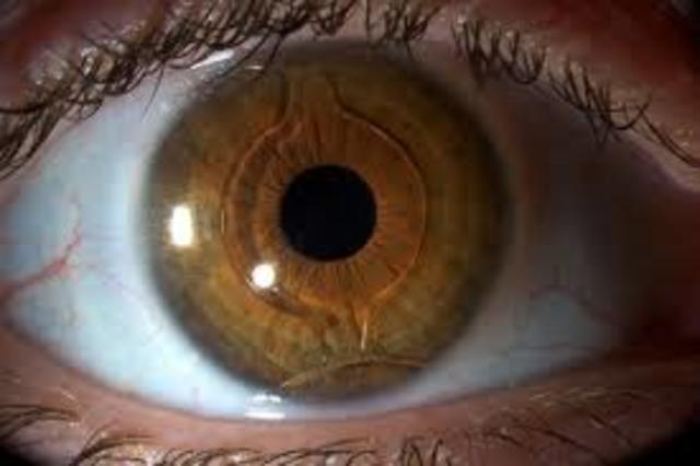 Implante de lentes intraculares y válvulas, 1952.