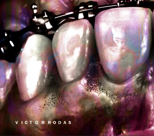 Protocolo para colocación de resinas