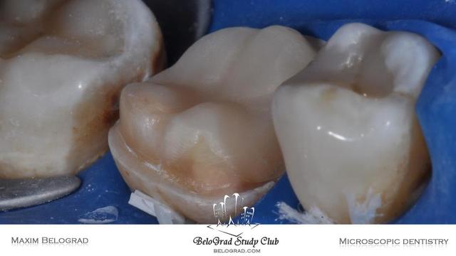 Diseño de la cavidad