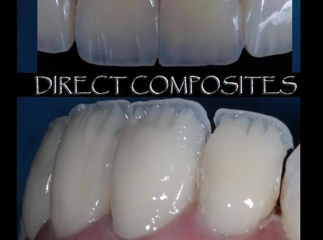 Técnica Estratificación