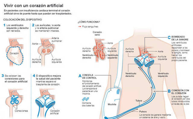 Primer corazón artificial en España