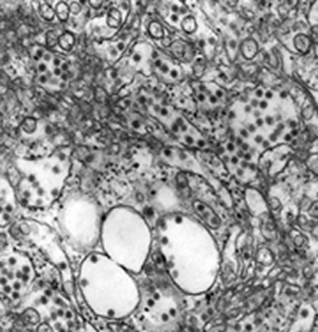 Tick-borne encephalitis