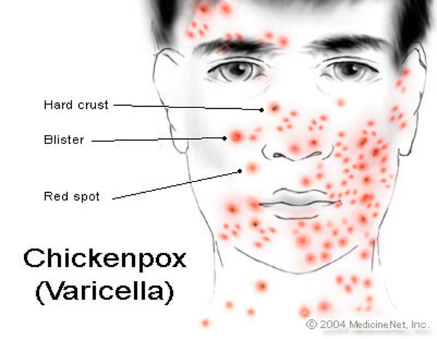 Chicken pox