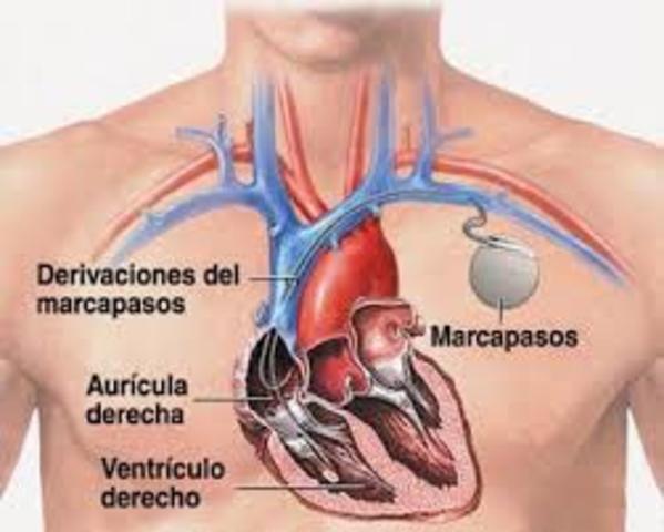 se implanta el primer marcapasos