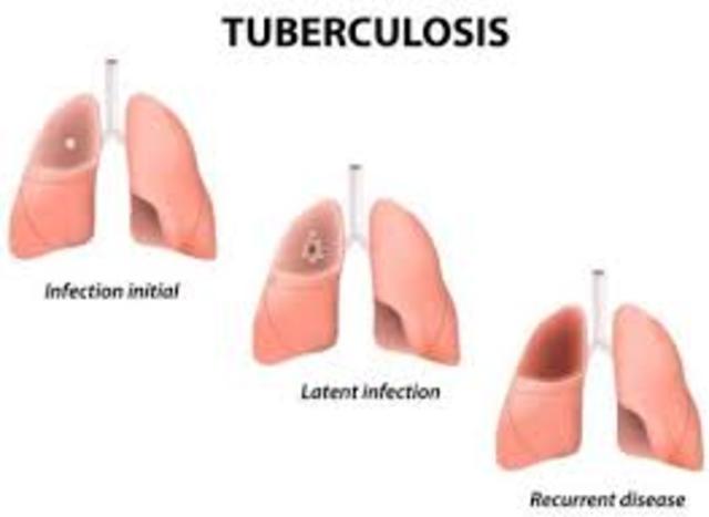 Tuberculosis