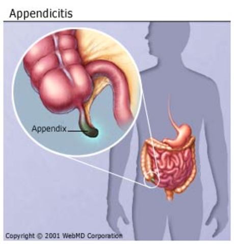 Appendicitis