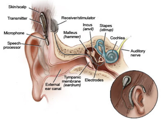 (Shook)- "First Cochlear Implant Implanted in Patient"