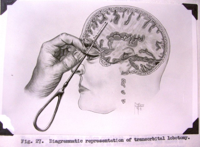 Lobotomy