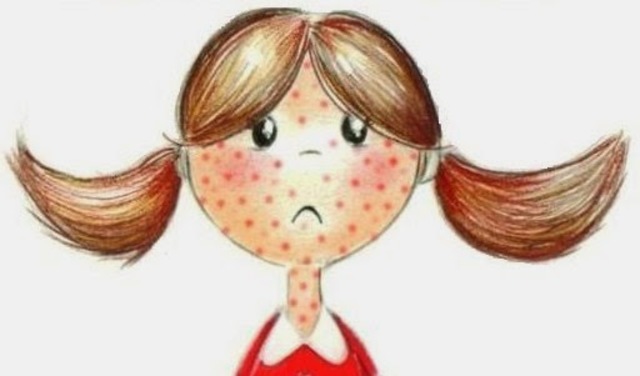 Cuando me dio varicela.