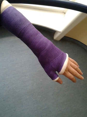 i broke my arm again