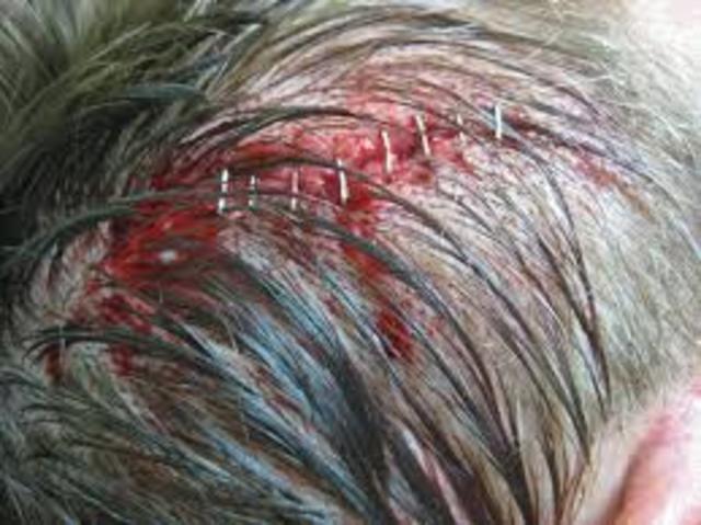 When i got my first Staples in my head