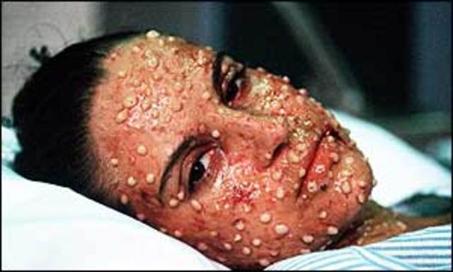 vacuna contra la viruela