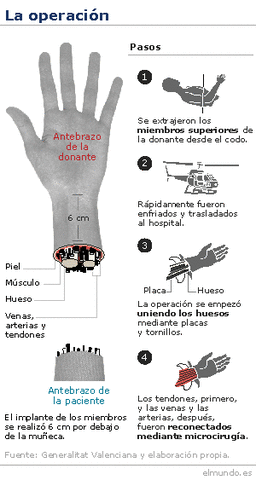 PRIMER IMPLANTE DE MANO