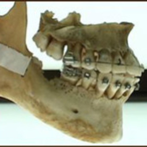 4 second dental match